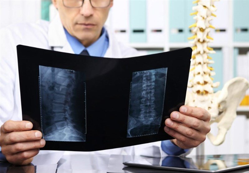 پوکی استخوان