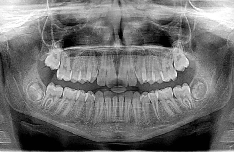 dental xray